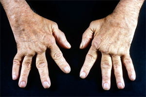 Following are the six common types of arthritis: